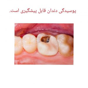 پوسیدگی دندان و عوامل آن. دلایل پوسیدگی دندان. مراحل پوسیدگی دندان. مجله سلامتی.